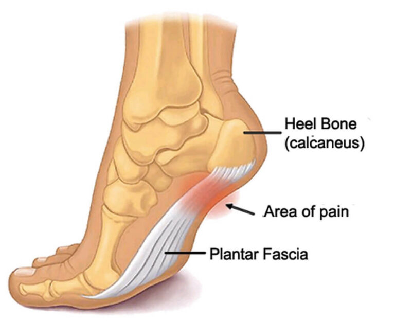 Best Shoes for Plantar Fasciitis